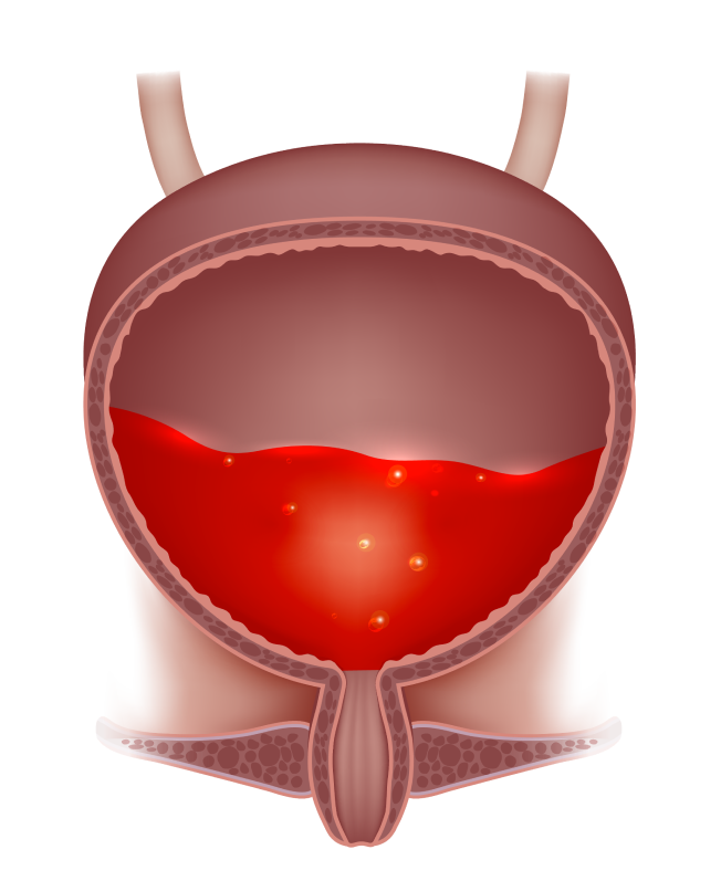 What Could’ve Caused Blood in the Urine?